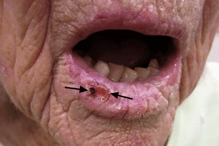 Skin cancer: Squamous cell carcinoma symptoms