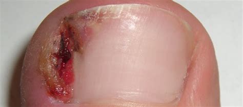 What Happens if an Ingrown Toenail Goes Untreated? Pain, Redness ...