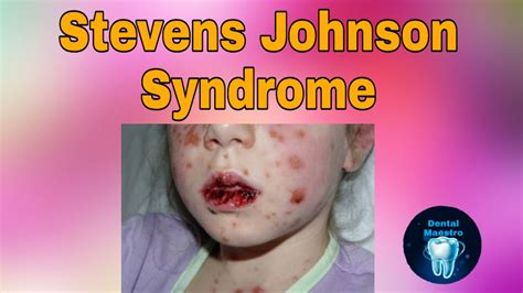 Stevens Johnson Syndrome | SJS | severe skin reaction | Dental Maestro ...