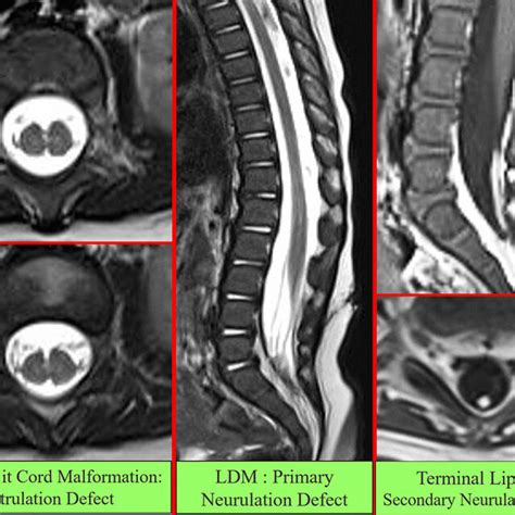 Limited dorsal myeloschisis involving one hemicord of a split cord ...