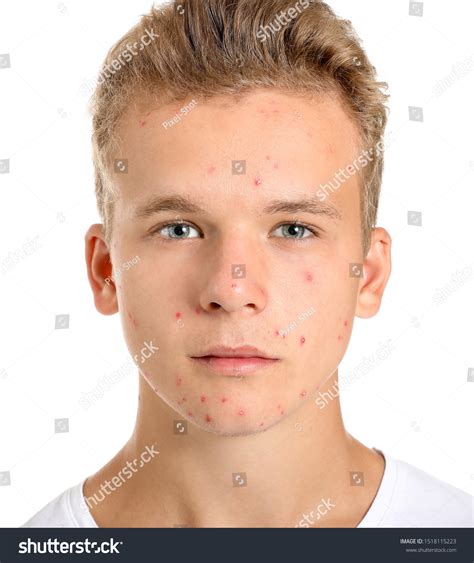 3,309 Pimple Face Boy Images, Stock Photos & Vectors | Shutterstock