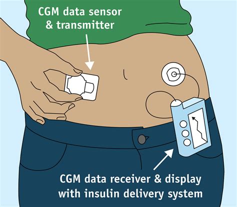 What Are The Benefits Of Continuous Glucose Monitoring - Printable Templates Protal
