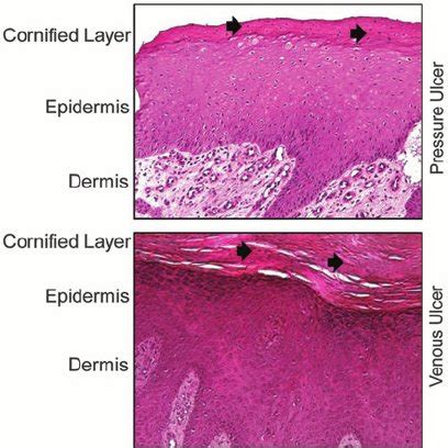 (PDF) Epithelialization in Wound Healing: A Comprehensive Review