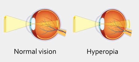 Long-sightedness (hyperopia)