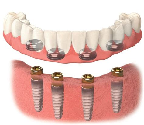 Implant-Supported Dentures that don't slip - Rancho San Diego Dental