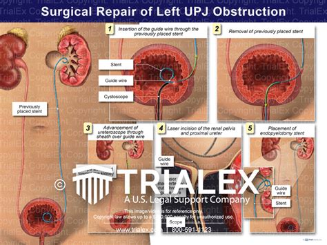 Surgical Repair of Left UPJ Obstruction - Trial Exhibits Inc.