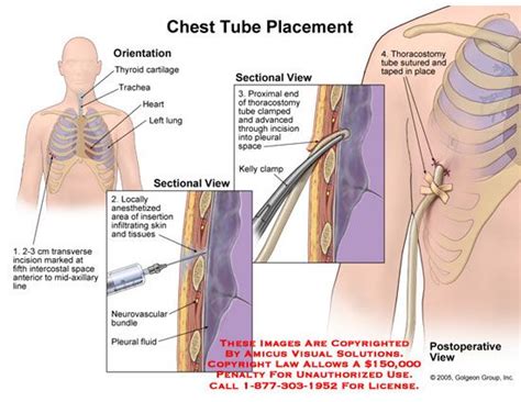 Chest Tube Placement | Nursing | Pinterest | Pictures, Search and Chest tube