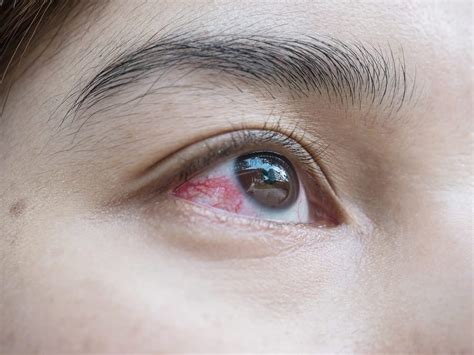 Broken Blood Vessel in Eye | Phoenix Eye Doctors