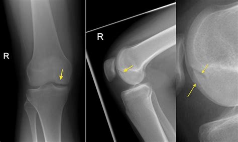 Osteochondral defect, knee - Radiology at St. Vincent's University Hospital