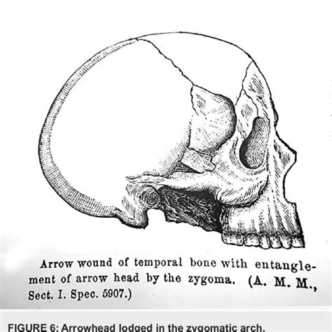 Figure copied from: Bill JH: Sabre and bayonet wounds; arrow wounds ...