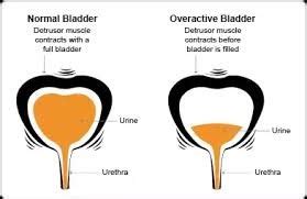 Overactive Bladder | Chin Chong Min Urology & Robotic Surgery Centre