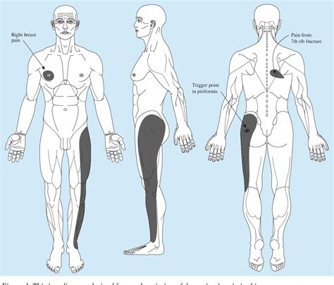 Piriformis Trigger Points