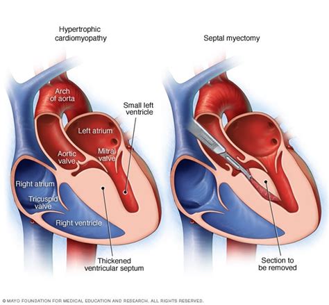 Hypertrophic cardiomyopathy - Diagnosis and treatment - Mayo Clinic