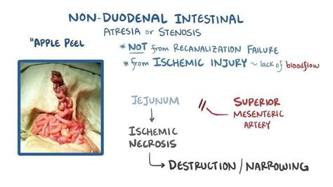 Intestinal atresia - Alchetron, The Free Social Encyclopedia