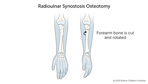 Radioulnar synostosis | Boston Children's Hospital - ob欧宝体育app下载