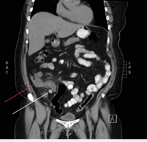 CT scan of the abdomen and pelvis with oral contrast (coronal slice).... | Download Scientific ...