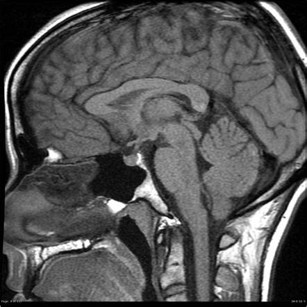 Pituitary Tumor Mri