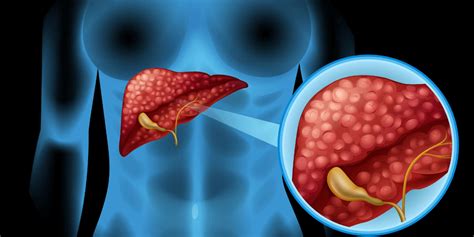 Everything You Must Know About Cholestatic Liver Disease