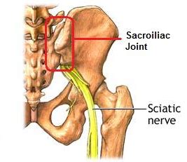 Sciatica versus Sacroiliac joint injuries - Two very different things! - Better Health Practice