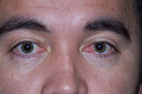 Pterygium Symptoms, Signs, Treatments, Recovery: Pre Pterygium Surgery Picture