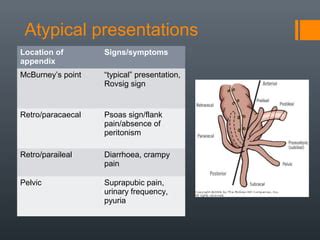 Acute appendicitis | PPT