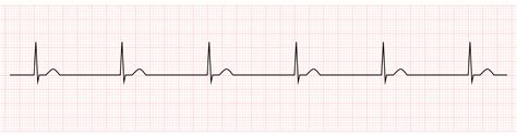 EKG Monitor Showing junctional escape rhythm 20203437 Vector Art at Vecteezy