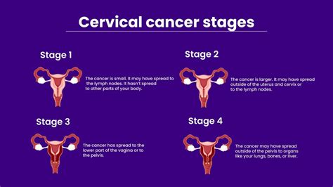 Different Stages Of Cervical Cancer