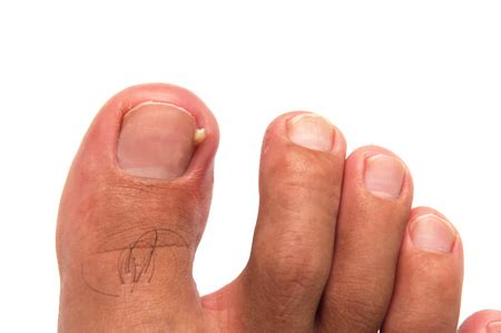 Learn About Ingrown Toenail Prevention | Your Next Step Podiatry