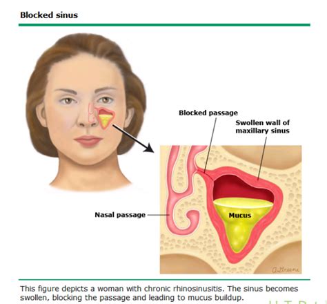 Information on Sinusitis - Melbourne ENT Group