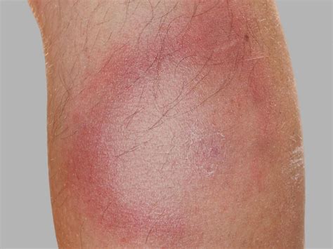 Lyme disease rash: Symptoms, stages, and identification | Lyme disease, Disease, Symptoms