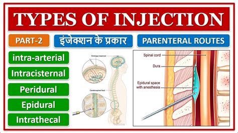 TYPES OF INJECTION | इंजेक्शन के प्रकार | PART-2 | INTRA-ARTERIAL | PERIDURAL-EPIDURAL ...