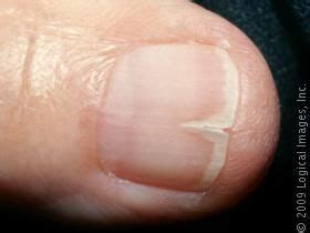 your fingers, they are said to be “clubbed”. Clubbed nails can mean ...