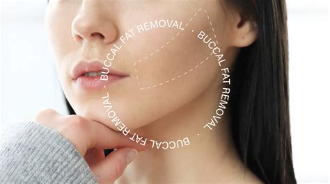 Is Buccal Fat Removal Safe? | Belo Medical Group