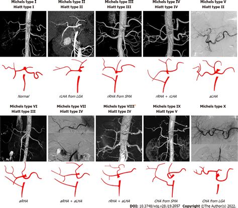 Hepatic Artery Branches