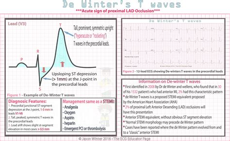 ECG Educator Blog : De Winters T waves