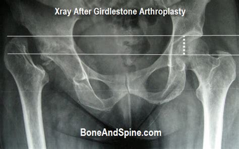 Girdlestone Procedure or Excision Arthroplasty of Hip | Bone and Spine