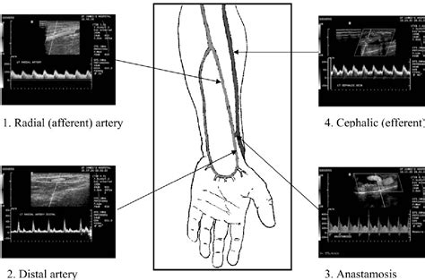 Figure 2 from Ultrasound of Haemodialysis Radiocephalic Fistula: A Pictorial Essay | Semantic ...