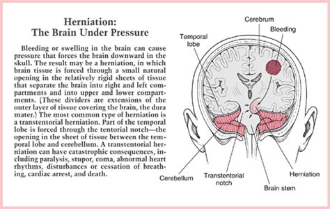 ICP:Increased Intracranial Pressure | Chiari malformation, Intracranial pressure, Chiari