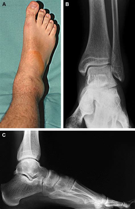 Subtalar Dislocations - Foot and Ankle Clinics