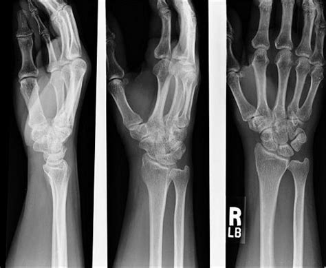 Upper Extremity X-Ray | Cedars-Sinai