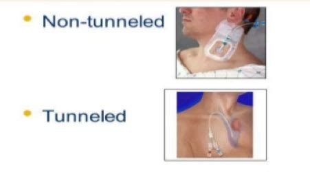 Catheter placement and maintenance