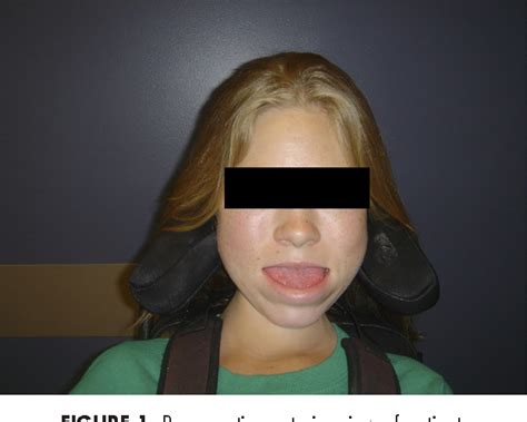 Figure 1 from Orthognathic surgery and partial glossectomy in a patient with merosin-deficient ...