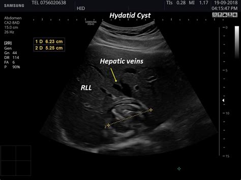 Hydatid cyst [1 image] – EFSUMB