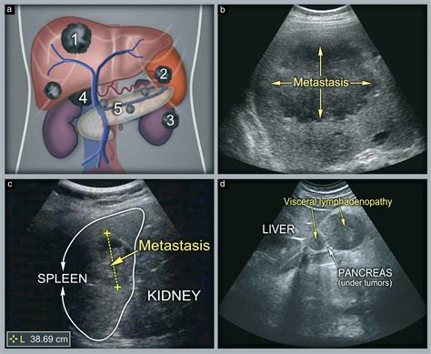 Vesicouterine Pouch Ultrasound