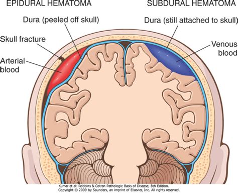 Jiu Jitsu Doc: All About Jiu Jitsu and Medicine!: Trauma: Blunt Trauma to the Head