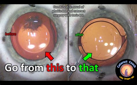 Cataract surgery & Phakic IOL removal – Cataract Coach