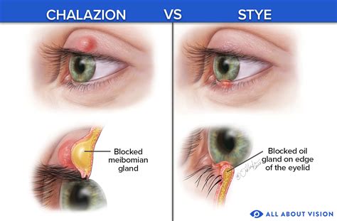 Chalazion & Styes - Lutz, FL: Sara Creekmore, D.O.: Ophthalmologist & Eye Surgeon: Tampa Bay Eye ...