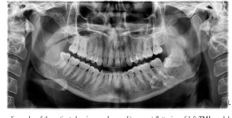 Pterygoid hamulus | Semantic Scholar