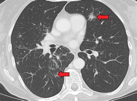 Noninfectious Granulomatous Diseases of the Chest | RadioGraphics