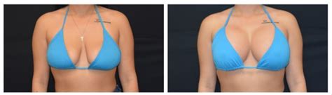 Breast Lift Exercises Before And After